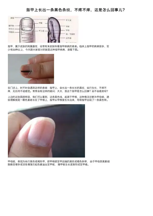 指甲上长出一条黑色条纹，不疼不痒，这是怎么回事儿？