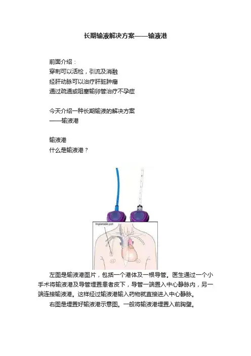 长期输液解决方案——输液港