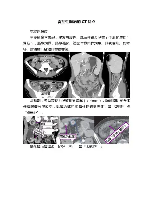 炎症性肠病的CT特点