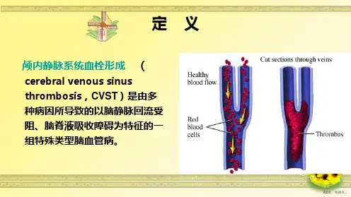 一例颅内静脉窦血栓形成病人的护理教学课件