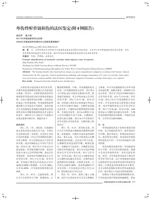 外伤性听骨链损伤的法医鉴定（附4例报告）