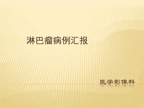 淋巴瘤病例汇报