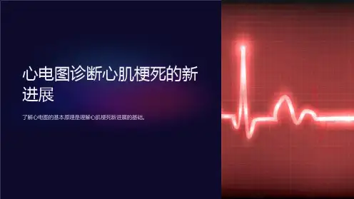 心电图诊断心肌梗死的新进展