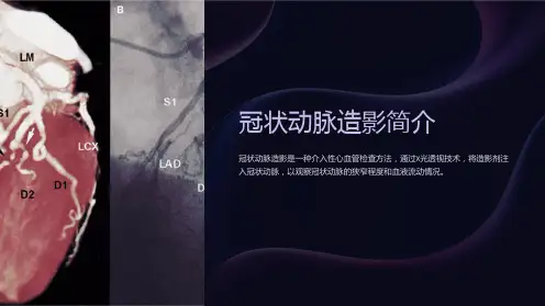 冠状动脉造影简介