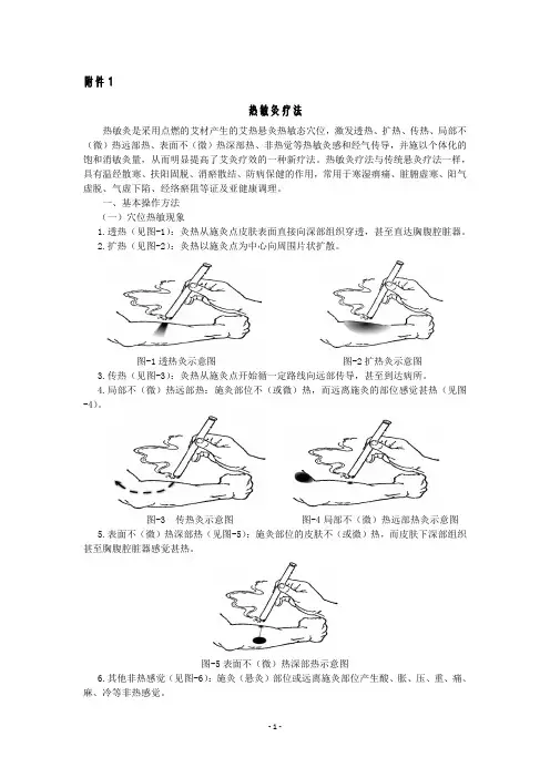 热敏灸疗法