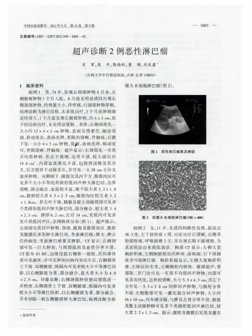 超声诊断2例恶性淋巴瘤