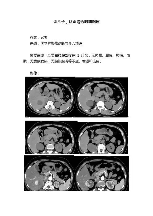 读片子，认识肾透明细胞癌