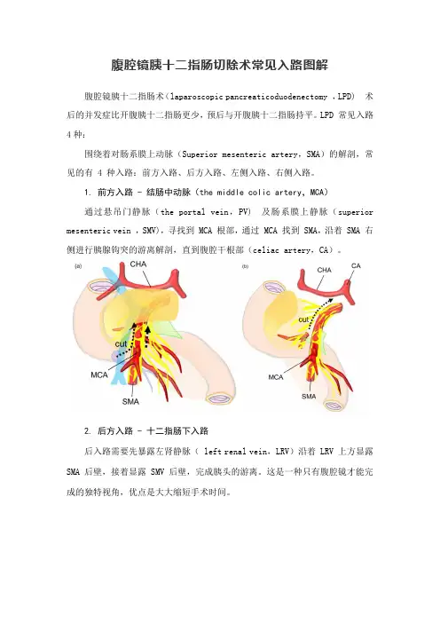 临床腹腔镜胰十二指肠切除术常见入路图解