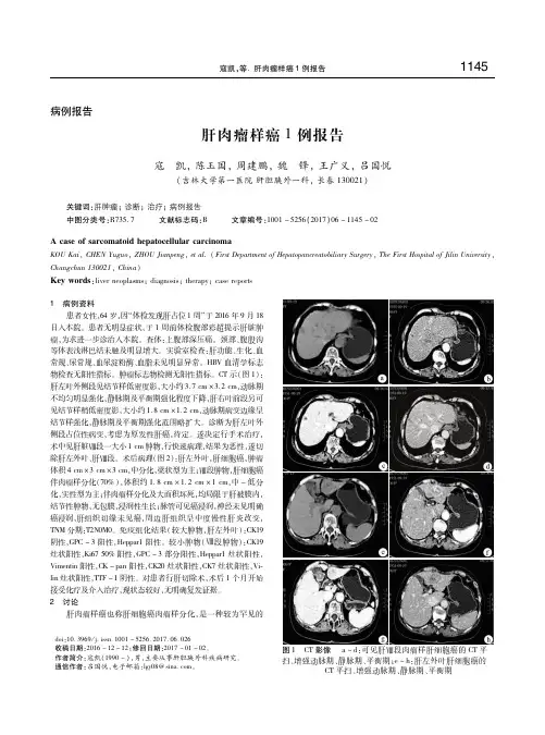肝肉瘤样癌1例报告 寇凯
