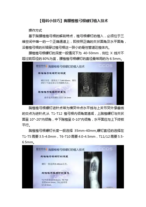 【骨科小技巧】胸腰椎椎弓根螺钉植入技术