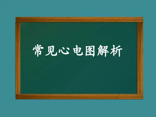 常见心电图解析PPT课件