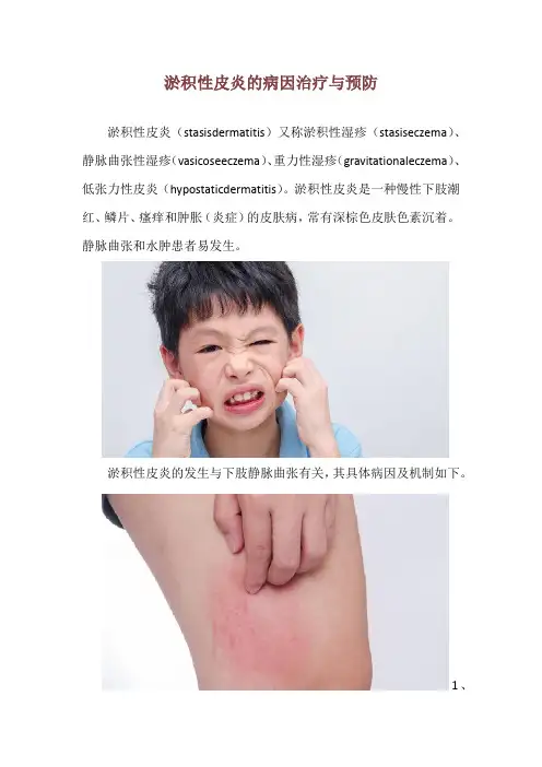 淤积性皮炎的病因治疗与预防