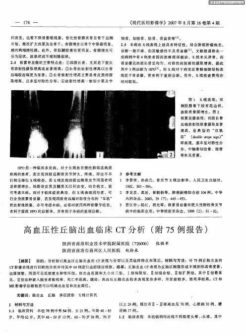 高血压性丘脑出血临床CT分析(附75例报告)