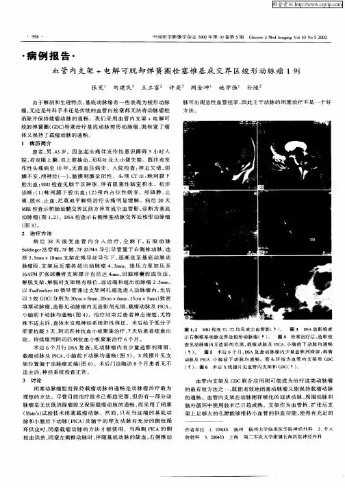 血管内支架+电解可脱卸弹簧圈栓塞椎基底交界区梭形动脉瘤1例
