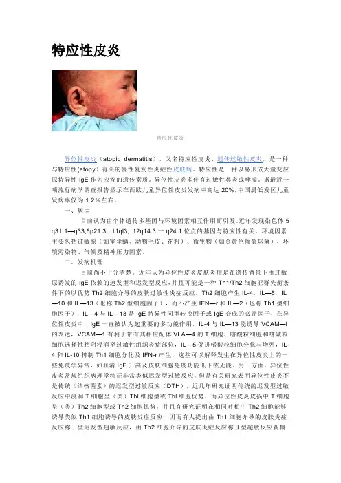 特应性皮炎