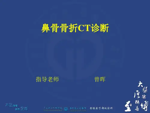鼻骨骨折CT诊断 ppt课件