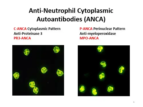 ANCA相关性血管炎肾损害病理表现课件