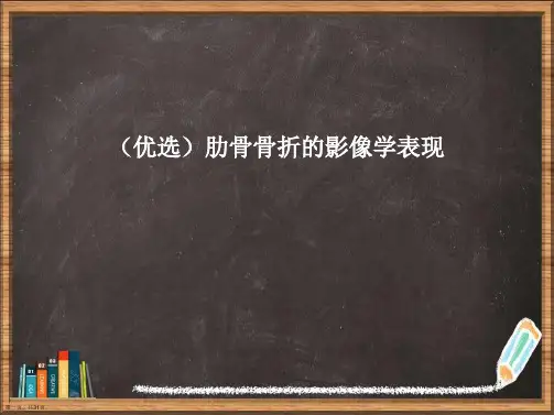 优选肋骨骨折的影像学表现演示ppt