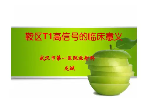 龙斌.鞍区T1高信号的临床意义