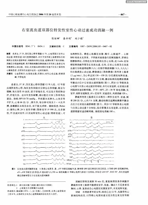 右室流出道双部位特发性室性心动过速成功消融一例