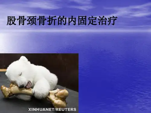 股骨颈骨折的内固定治疗