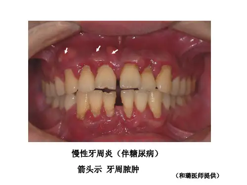 牙 周 病 学 第四版 7
