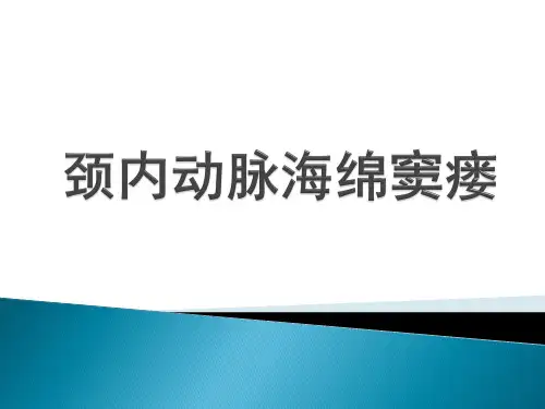 颈内动脉海绵窦瘘 ppt课件