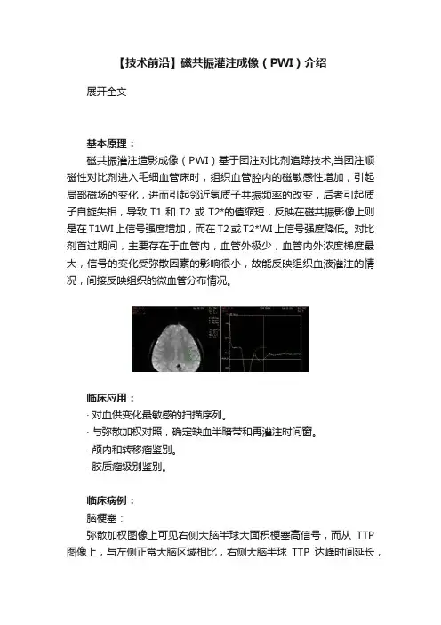 【技术前沿】磁共振灌注成像（PWI）介绍