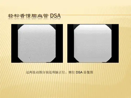 DSA全脑血管造影术PPT课件
