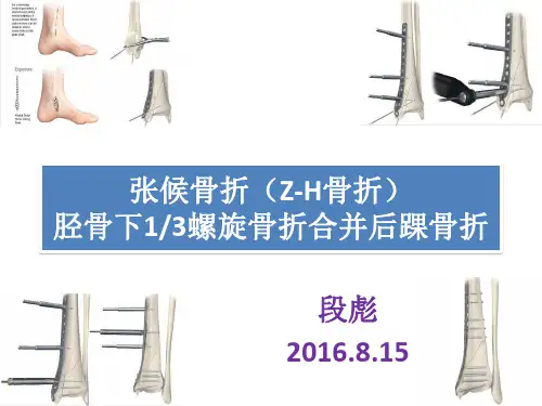 张候(Z-H)骨折