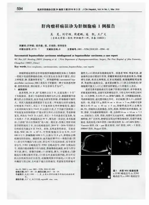 肝肉瘤样癌误诊为肝细胞癌1例报告