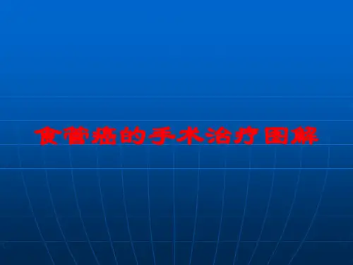食管癌的手术治疗图解培训课件