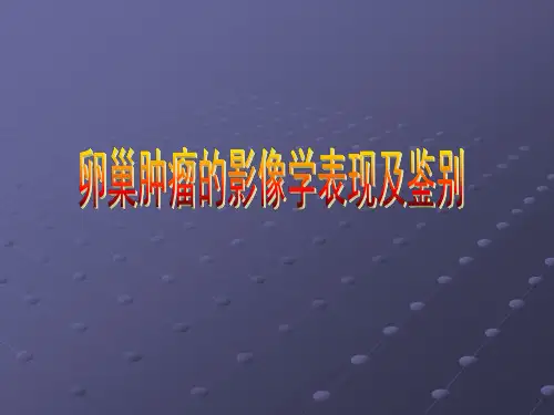 卵巢肿瘤的CT及MRI表现及鉴别