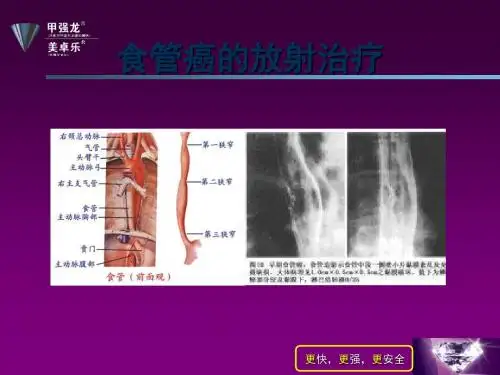 食管癌的放射治疗PPT课件