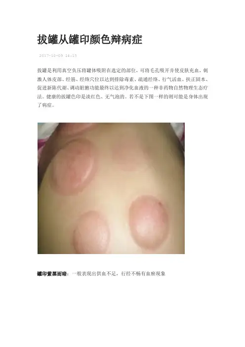 拔罐从罐印颜色辩病症