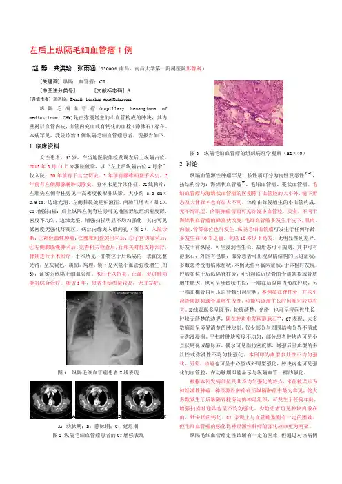 左后上纵隔毛细血管瘤1例