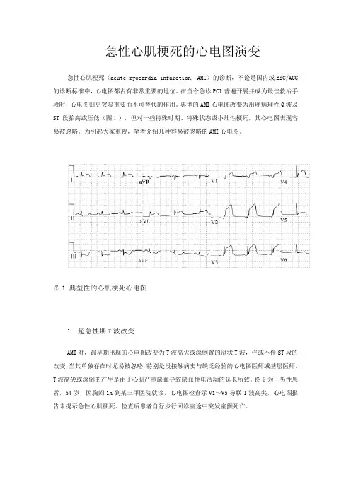 急性心肌梗死的心电图演变