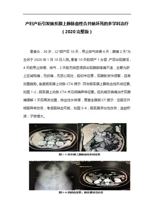 产妇产后引发肠系膜上静脉血栓合并肠坏死的多学科治疗(2020完整版)