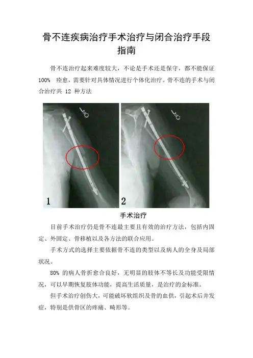 骨不连疾病手术治疗与闭合治疗手段指南