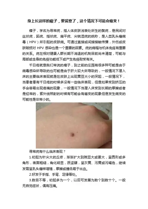 身上长这样的瘊子，要留意了，这个情况下可能会癌变！