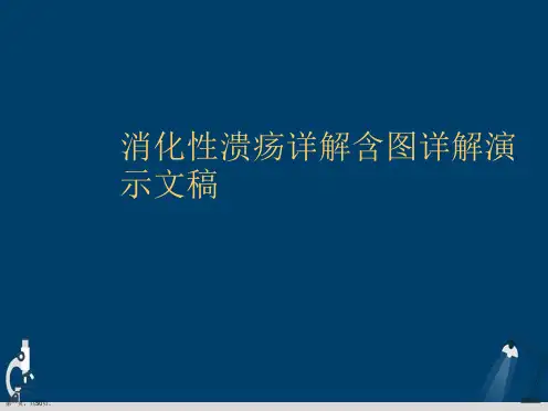 消化性溃疡详解含图详解演示文稿