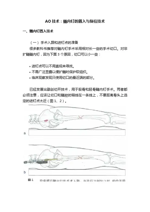 AO技术：髓内钉的置入与复位技术