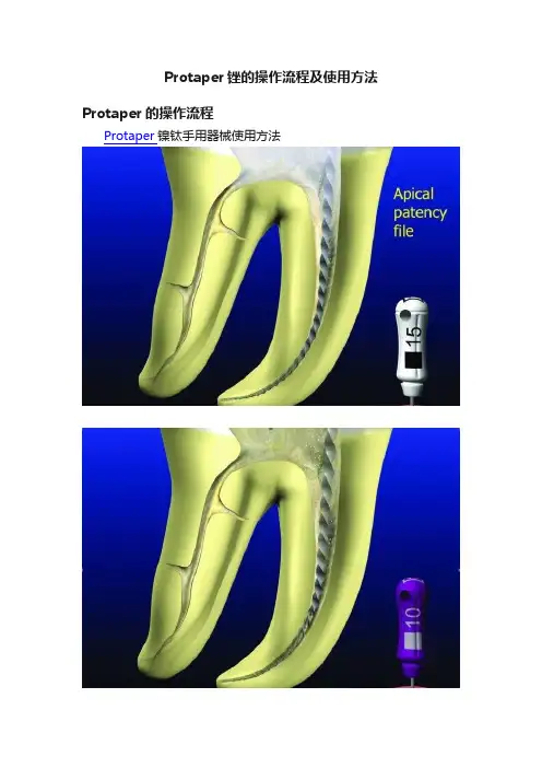 Protaper锉的操作流程及使用方法