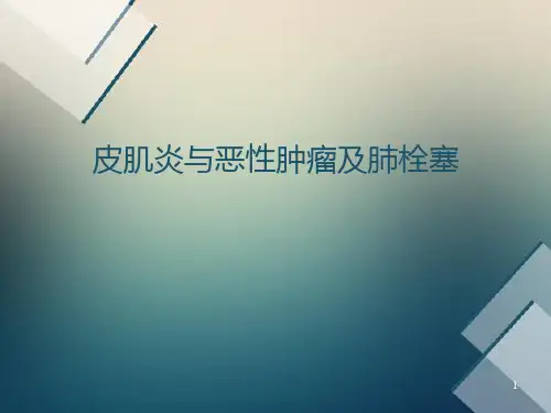 皮肌炎与恶性肿瘤及肺栓塞ppt课件
