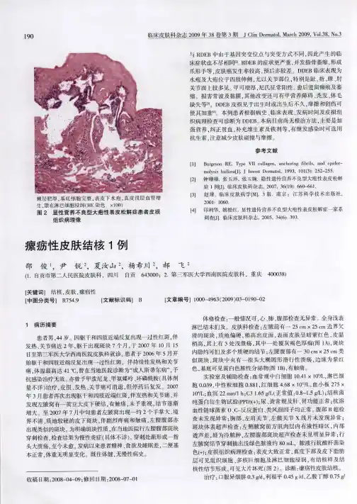 瘰疬性皮肤结核1例