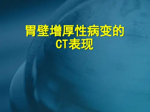 胃壁增厚性病变的CT表现_