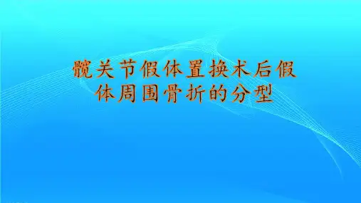 髋关节假体置换术后假体周围骨折的分型