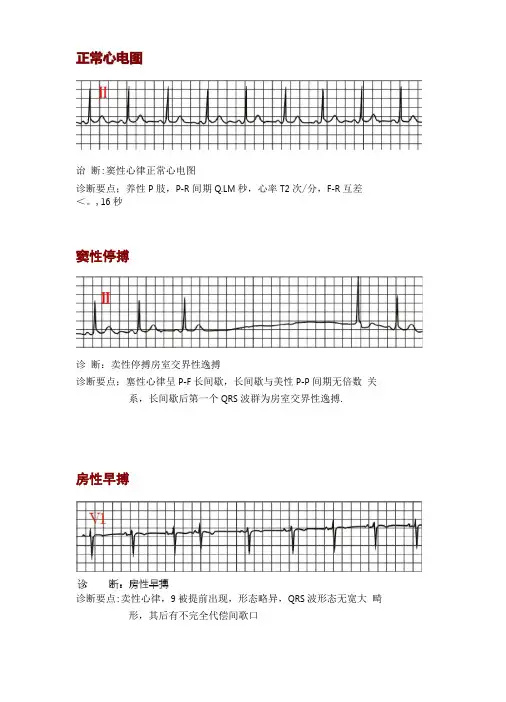 心电图典型图谱