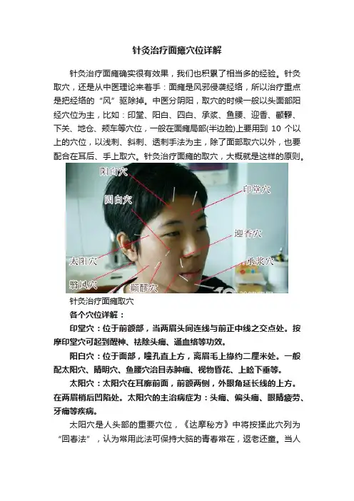 针灸治疗面瘫穴位详解