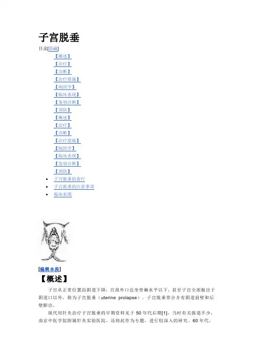 子宫脱垂